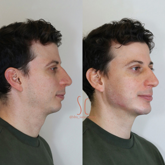 Harmonização Masculina
