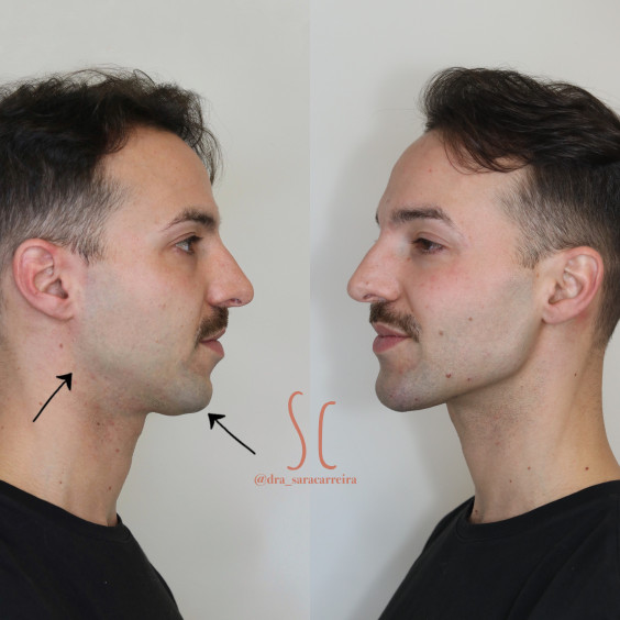 Harmonização Masculina