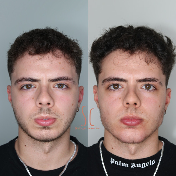 Harmonização Masculina
