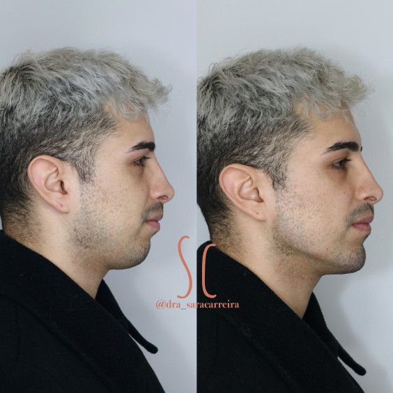 Harmonização Masculina