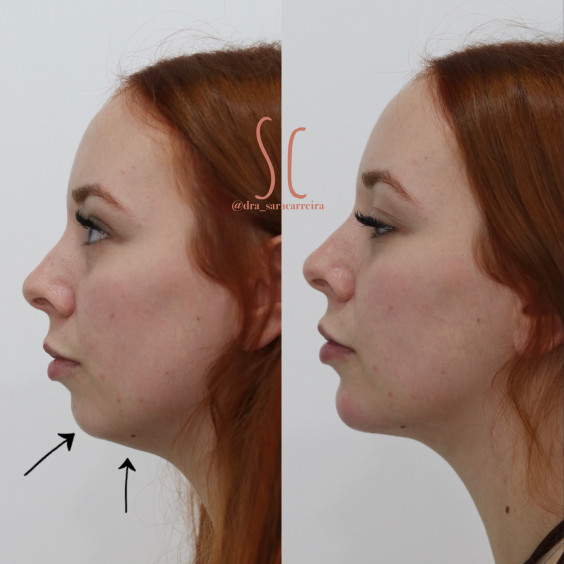 Perfiloplastia