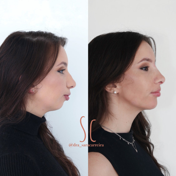 Perfiloplastia