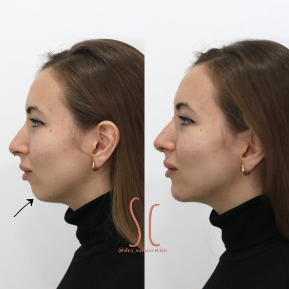 Perfiloplastia