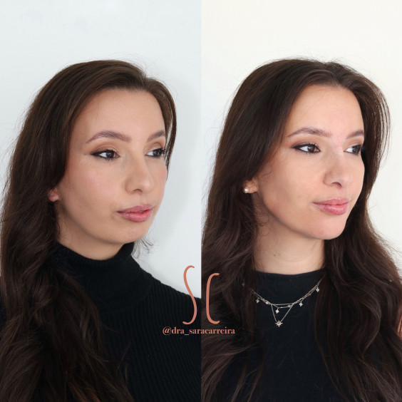 Perfiloplastia