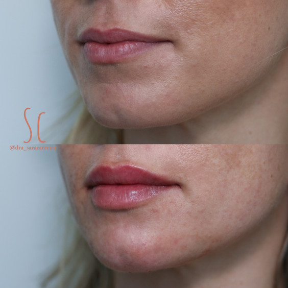 Preenchimento Labial