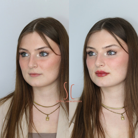 Preenchimento Labial