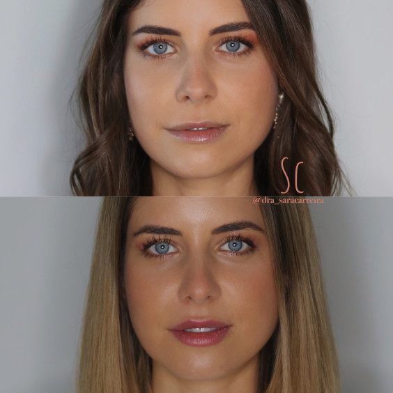 Preenchimento Labial