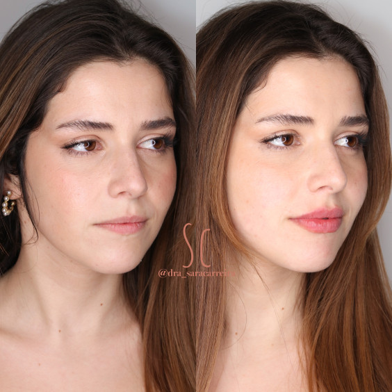 Preenchimento Labial