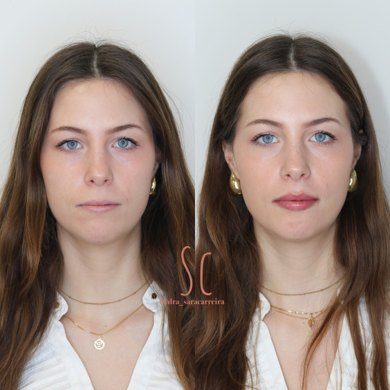 Preenchimento Labial