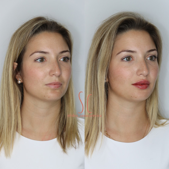 Preenchimento Labial