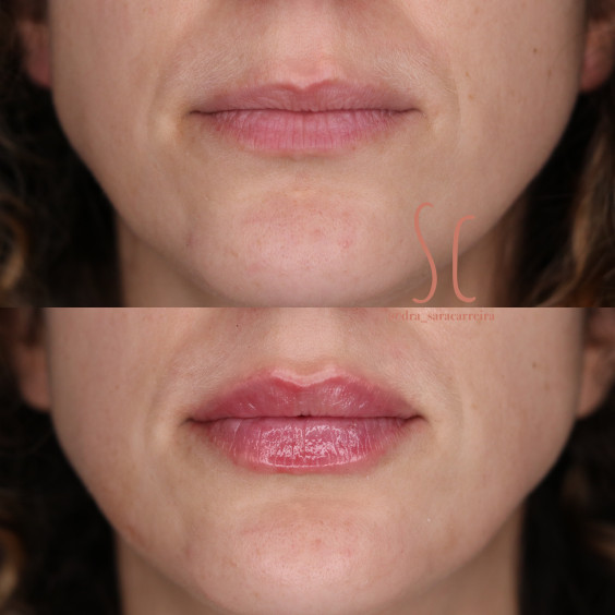 Preenchimento Labial