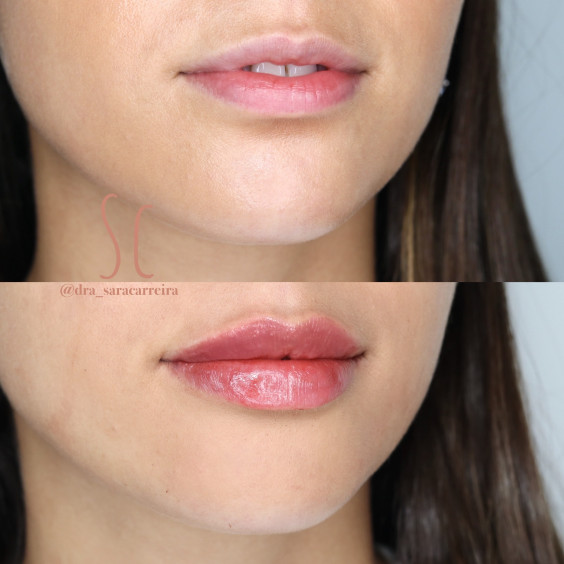 Preenchimento Labial