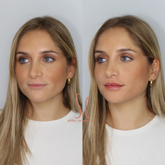 Preenchimento Labial