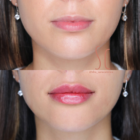Preenchimento Labial