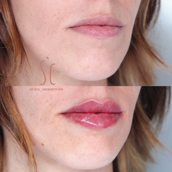 Preenchimento Labial