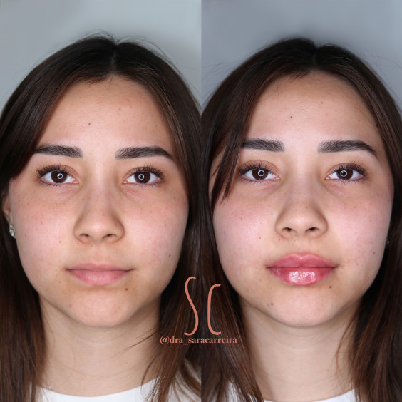 Preenchimento Labial