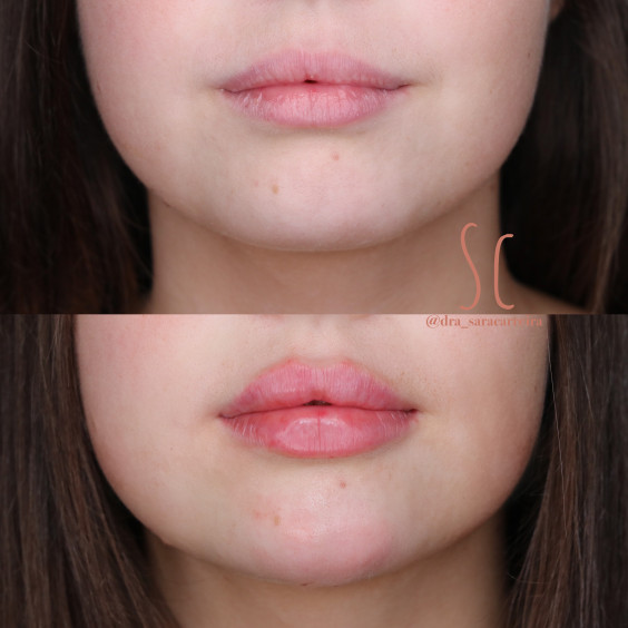 Preenchimento Labial