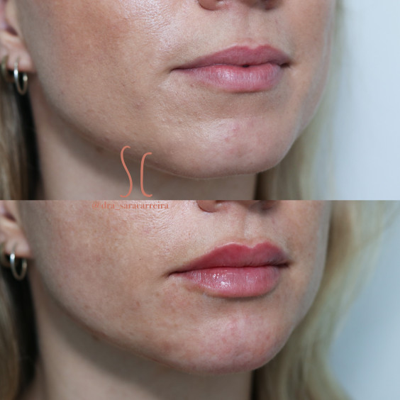 Preenchimento Labial