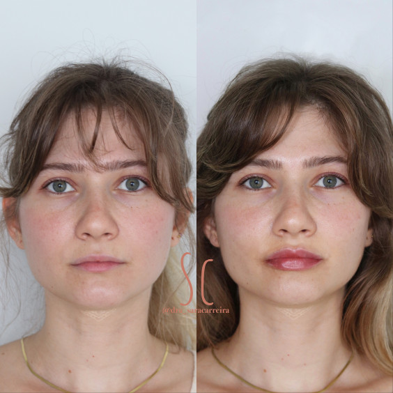 Preenchimento Labial