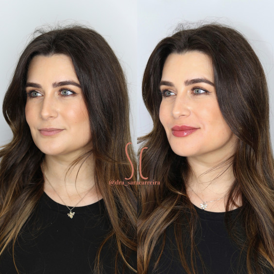 Preenchimento Labial