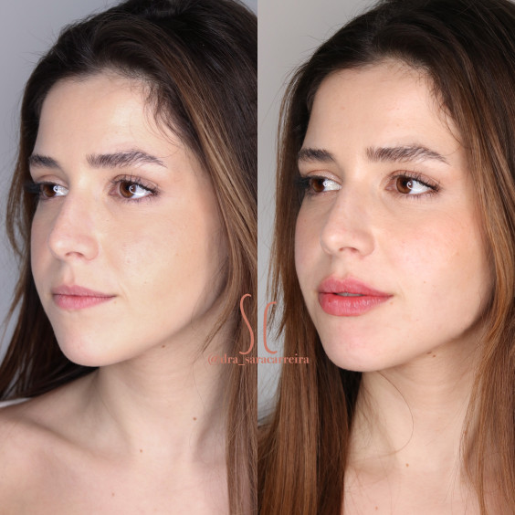 Preenchimento Labial