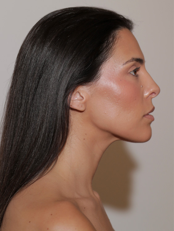 Perfiloplastia