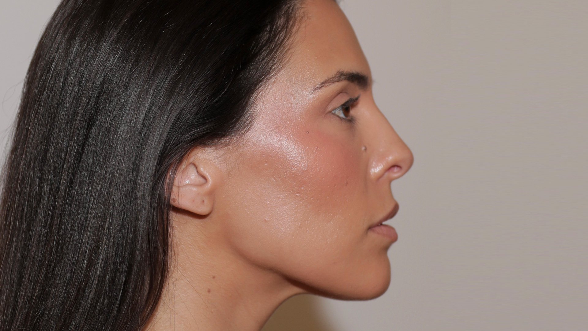 Perfiloplastia