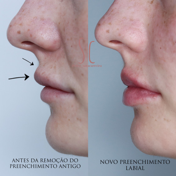 Remoção de Preenchimentos