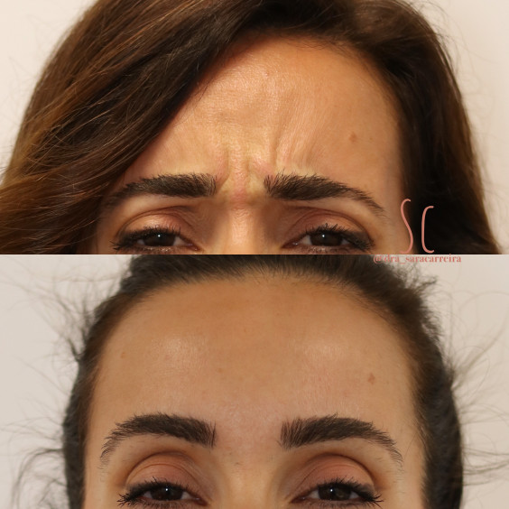Toxina Botulínica