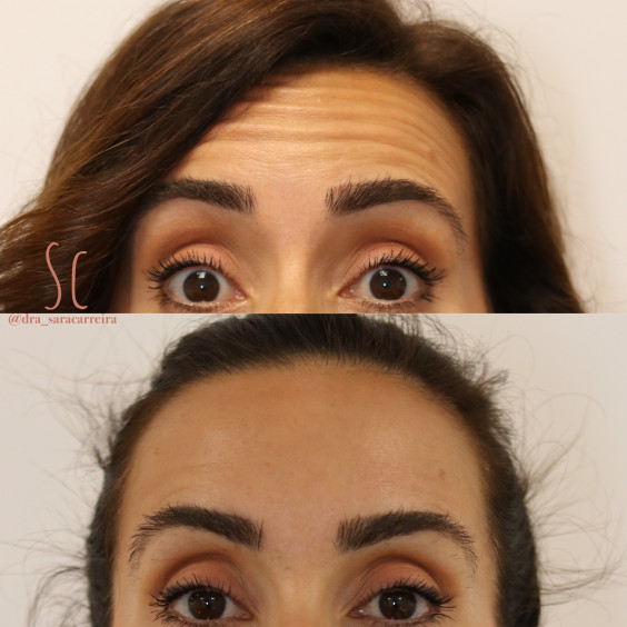 Toxina Botulínica